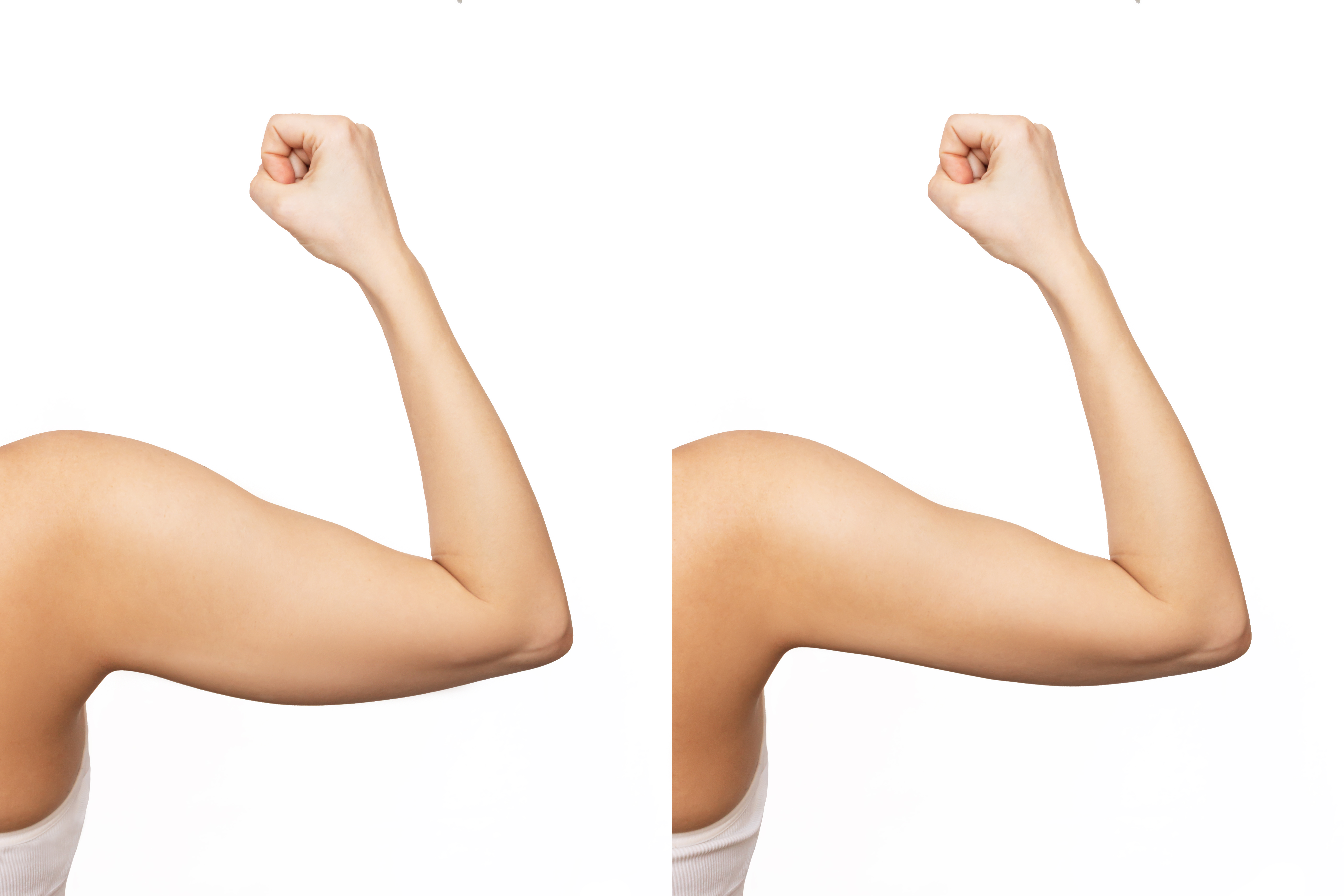 arm lift before and after-2 