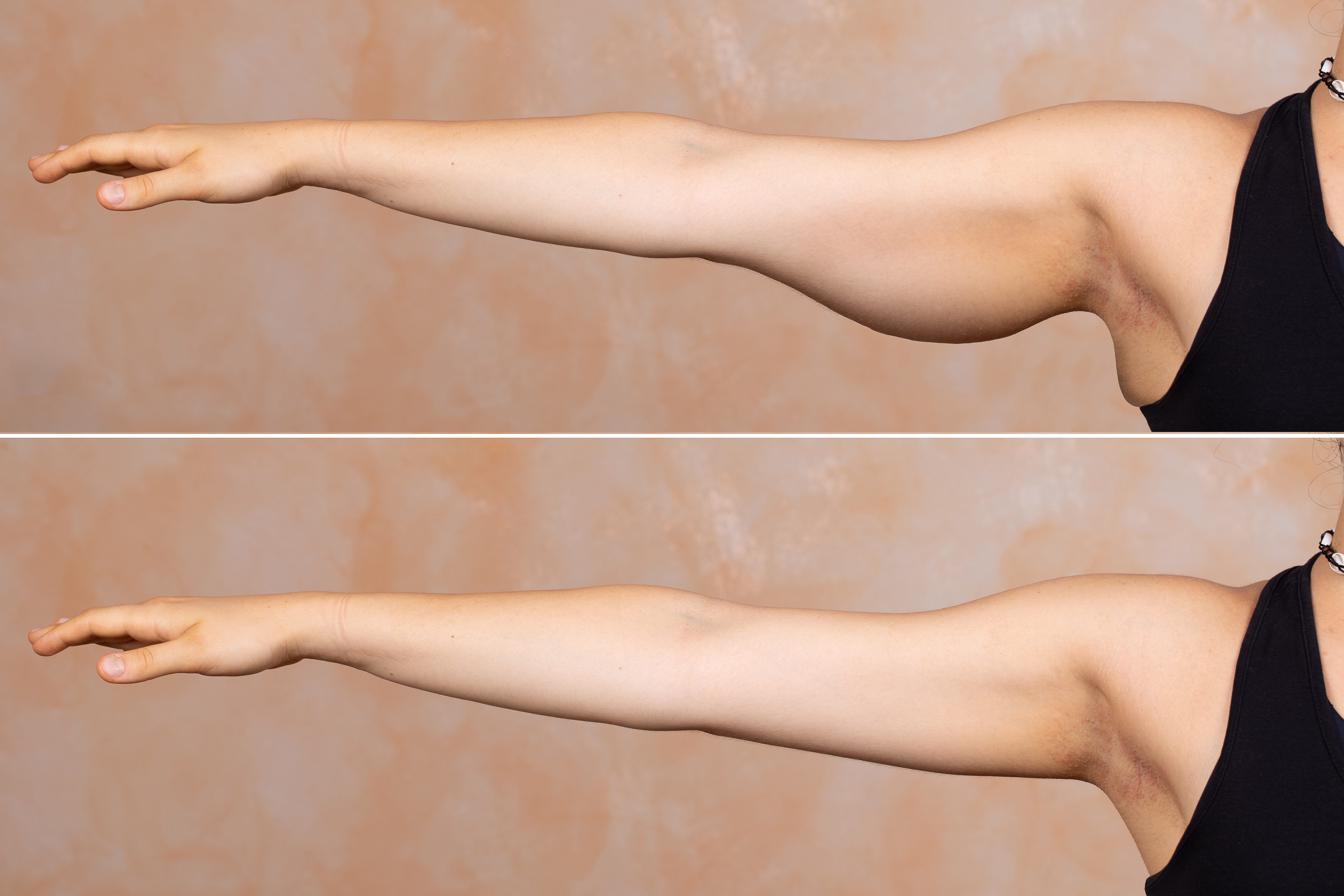 arm lift before and after-3 