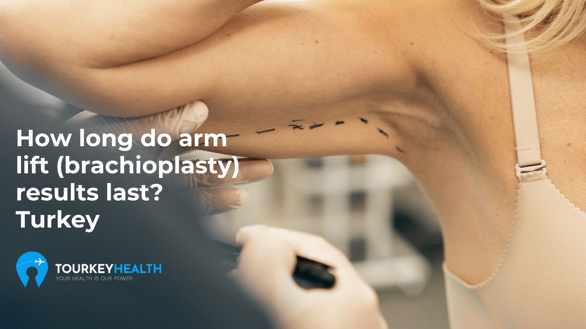 how-long-do-armlift-results-last?