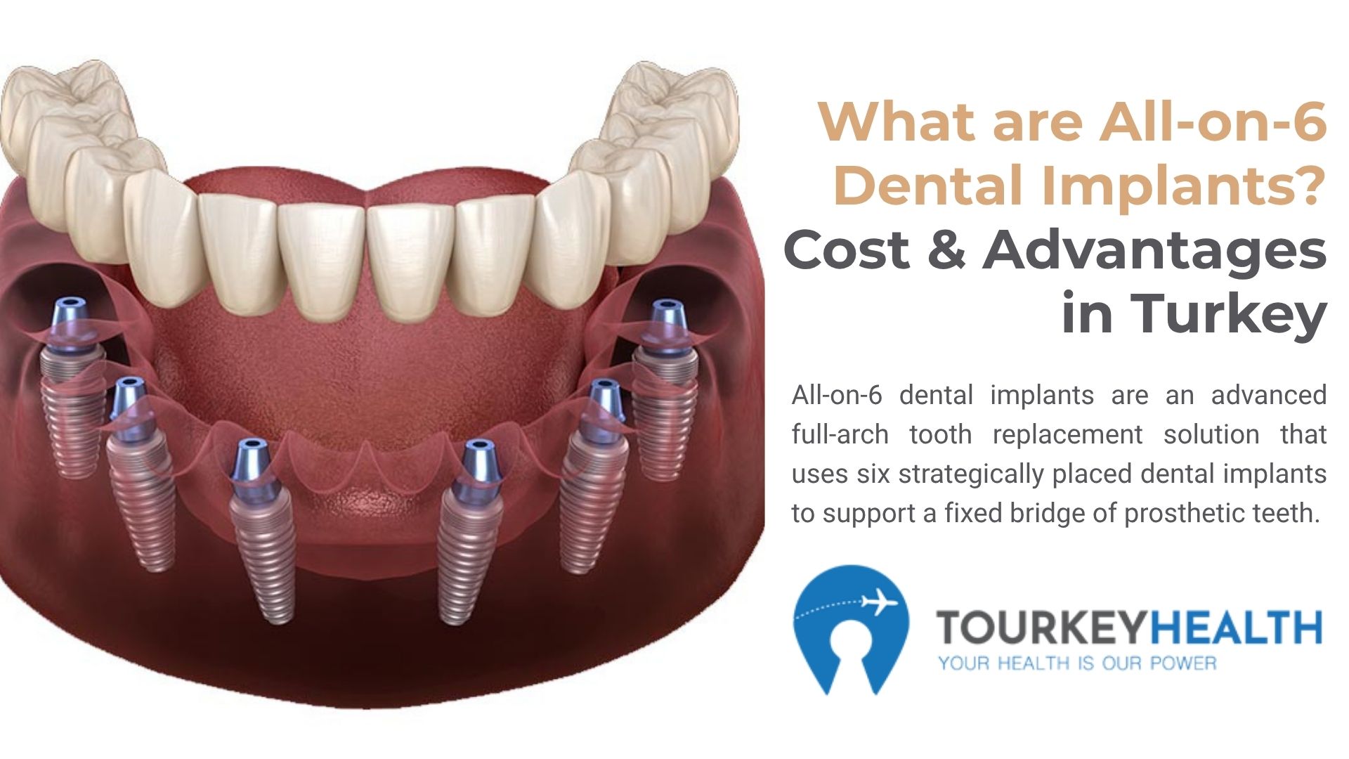 what-are-all-on-6-dental-implant-in-turkey?