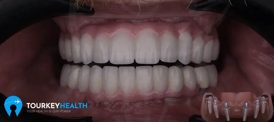 what-is-the-all-on-six-implant-process-turkey